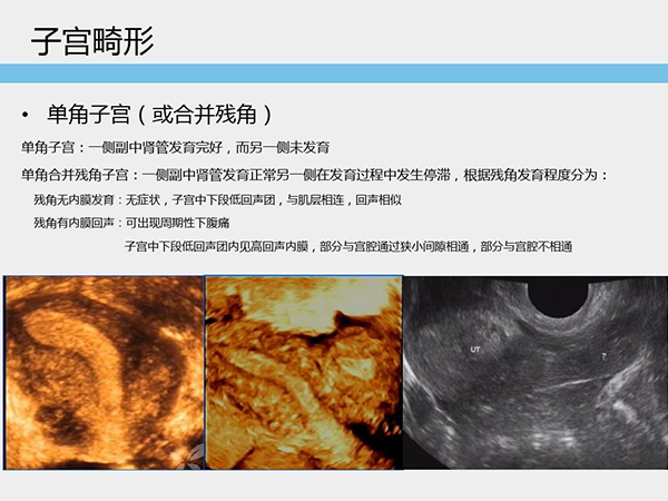 先天性子宫畸形易引发流产