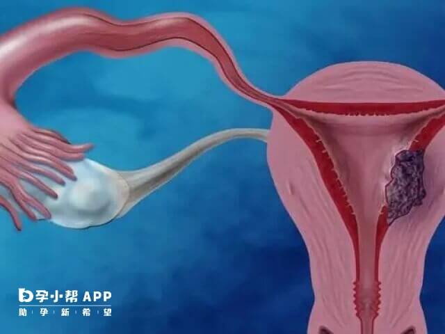 巧克力囊腫做試管移植一次成功概率不高