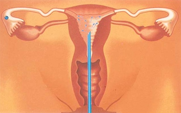人工授精不用打麻藥疼痛感能接受