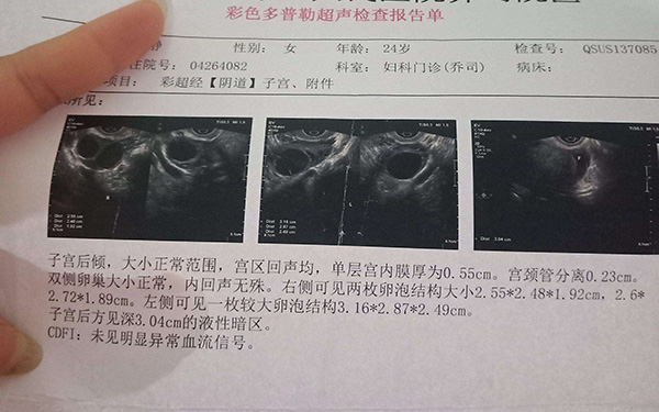 卵泡12*12是优势卵泡