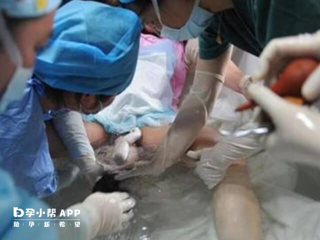 水中分娩開5指才下水已經晚了