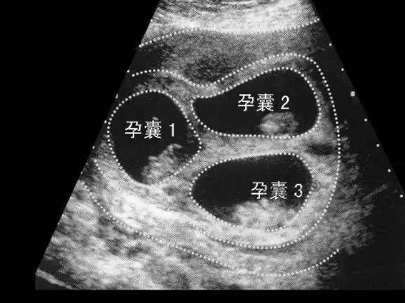 北医三院减胎挂生殖科