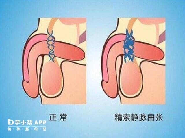 精索靜脈曲張偏方
