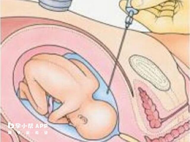 絨毛穿刺一般在懷孕16到22周之間做