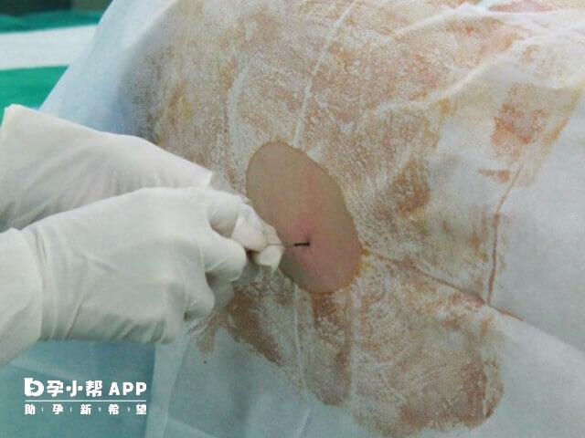 做宮腔鏡檢查要全麻