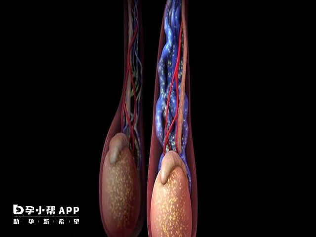 民間治療精索靜脈曲張的特效偏方