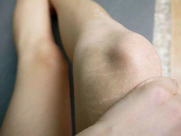 未婚女性肚子有妊娠紋