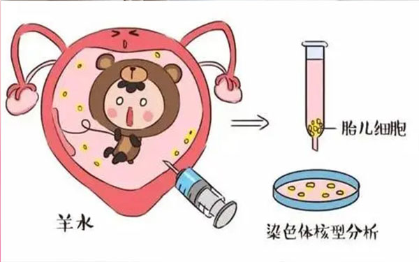 羊水穿刺可以检测胎儿性别