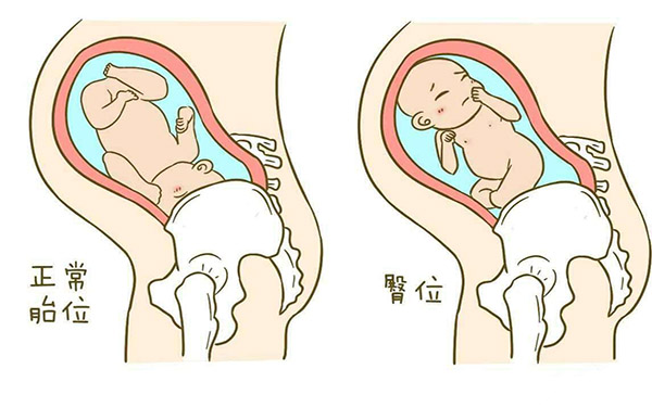 胎儿臀位38周入院待产最好