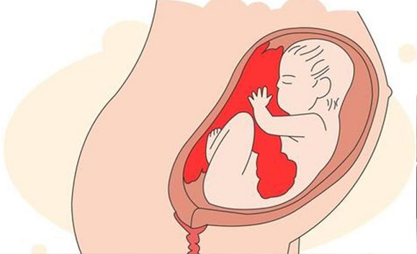 安寶對胎盤前置出血有一定治療作用