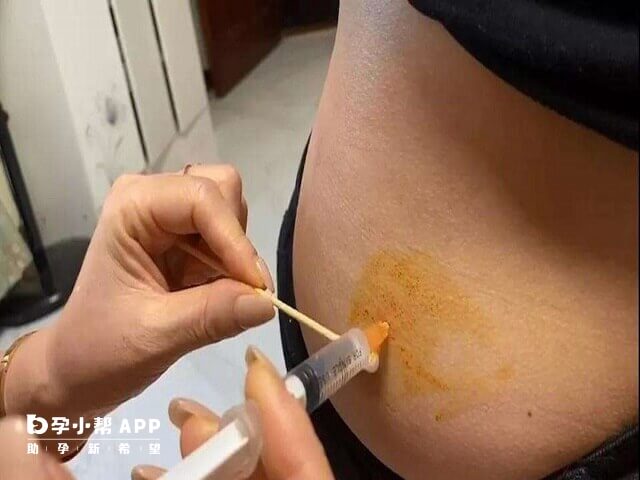 内异症用试管长方案促排好